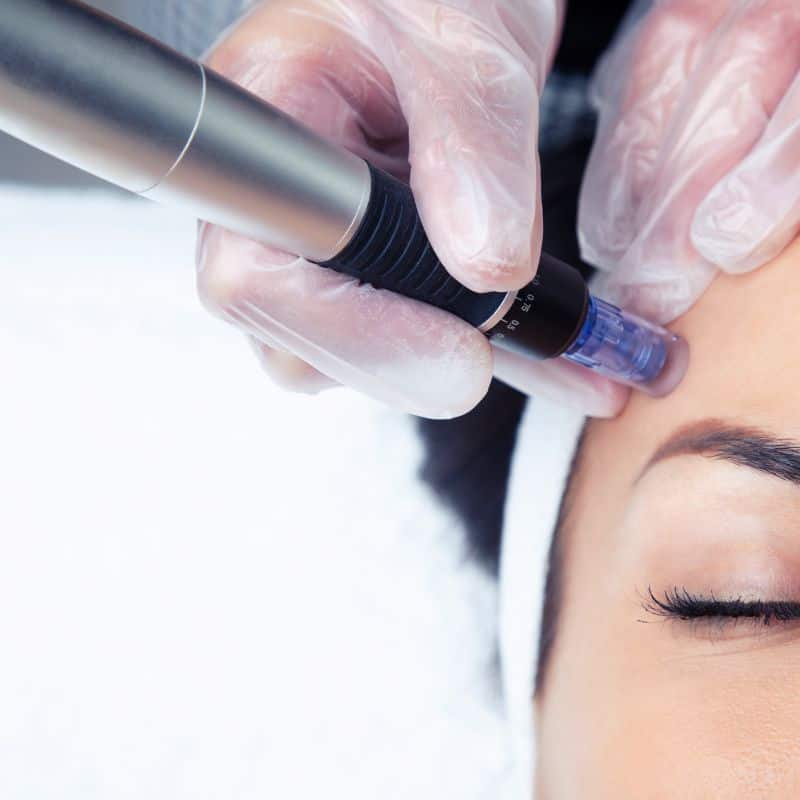 Morpheus8 treatment Greenock from Lipo Sculpt - Book in today!
